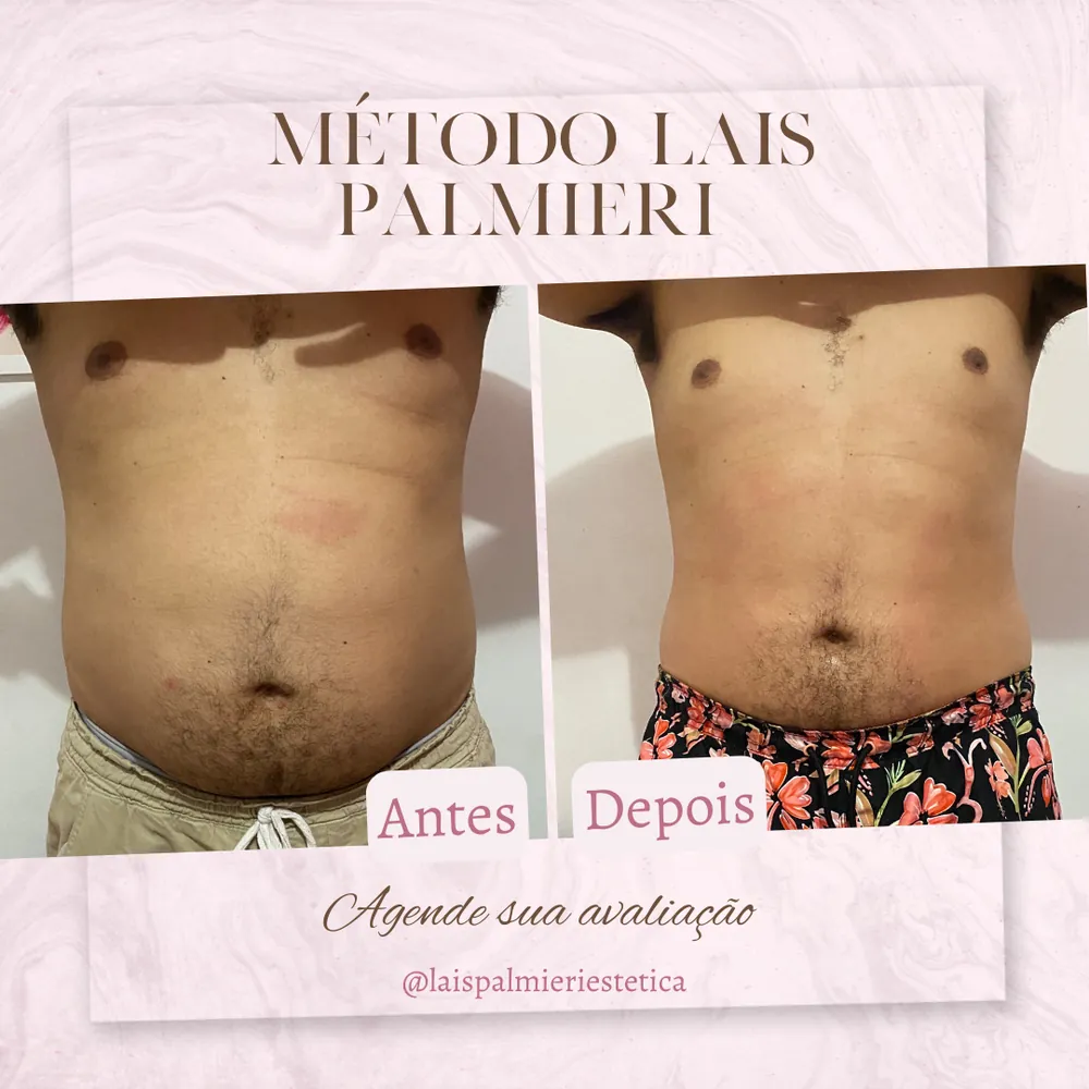 Antes e depois de redução de medidas, Método Laís Palmieri