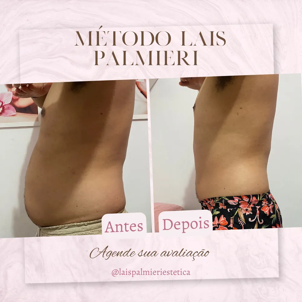 Antes e depois de contorno corporal, Método Laís Palmieri